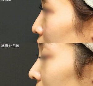 「鼻整形」ナチュラルな変化でコンプレックス解消１ヶ月後002